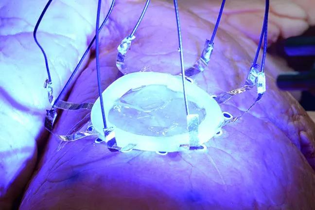 如何在扩张的肺部上3D打印一个柔性医疗传感器？
